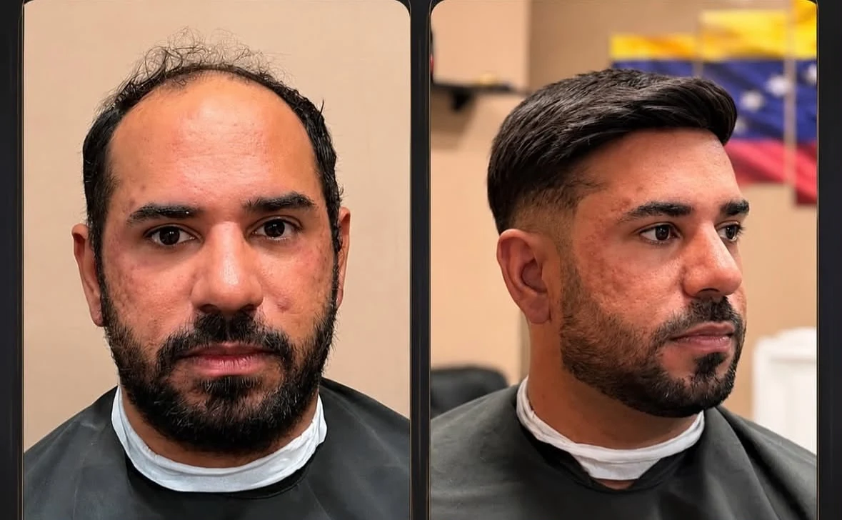 Antes e depois frontal de prótese capilar