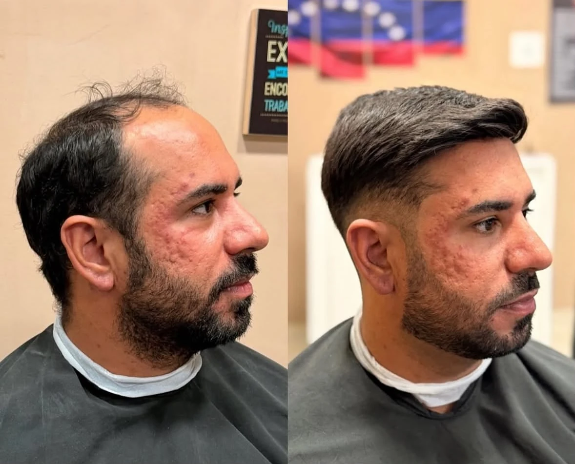 Comparativo antes e depois de prótese capilar