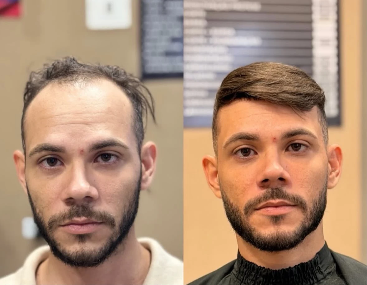 Transformação com prótese capilar